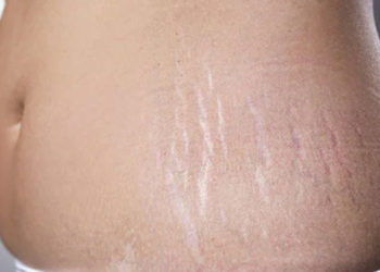 വയറിലെ സ്ട്രെച്ച് മാർക്ക് മാറാൻ വീട്ടില് പരീക്ഷിക്കാം ഈ വഴികൾ