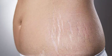 വയറിലെ സ്ട്രെച്ച് മാർക്ക് മാറാൻ വീട്ടില്‍ പരീക്ഷിക്കാം ഈ  വഴികൾ