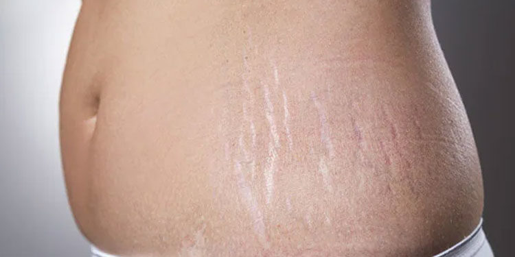 വയറിലെ സ്ട്രെച്ച് മാർക്ക് മാറാൻ വീട്ടില് പരീക്ഷിക്കാം ഈ  വഴികൾ