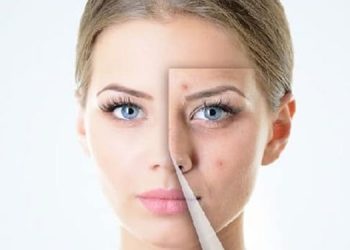 മുഖക്കുരുവിന്റെ പാടുകൾ അകറ്റാൻ ഇതാ  സിമ്പിൾ ടിപ്സ്