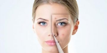 മുഖക്കുരുവിന്റെ പാടുകൾ അകറ്റാൻ ഇതാ  സിമ്പിൾ ടിപ്സ്