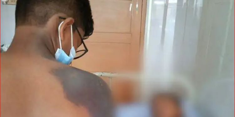 ഉപ്പിലിട്ടതു വില്ക്കുന്ന കടയില് നിന്ന് രാസവസ്തു കുടിച്ചു ; കുട്ടികള്ക്കു പൊള്ളലേറ്റു