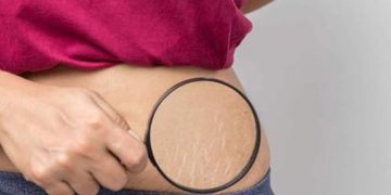 പ്രസവശേഷമുളള സ്ട്രെച്ച് മാർക്ക് മാറാൻ പരീക്ഷിക്കാം ഈ എളുപ്പ വഴികൾ