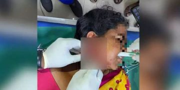 പല്ല് തേക്കുന്നതിനിടെ ടൂത്ത് ബ്രഷ് കവിളിൽ തുളഞ്ഞുകയറി : യുവതിക്ക് ശസ്ത്രക്രിയ