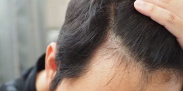 കോവിഡിനുശേഷം മുടികൊഴിച്ചിൽ , പരിചരിക്കേണ്ടത് ശിരോചർമം : ശ്രദ്ധിക്കാം