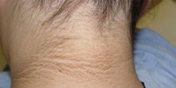 കഴുത്തിന് ചുറ്റുമുള്ള കറുപ്പ് അകറ്റാൻ ഇവ ഉപയോ​ഗിക്കാം