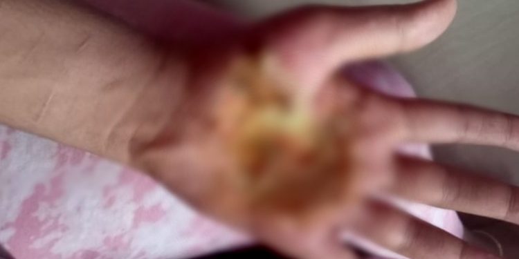 അന്ധവിശ്വാസത്തിന്റെ പേരിൽ ട്രാൻസ്‌വുമണിന്റെ കൈയിൽ കർപ്പൂരം കത്തിച്ചു