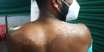 എന്തൊരു ചൂട്! സൂര്യാഘാതമേറ്റാല്‍ എന്തുചെയ്യണം? ശ്രദ്ധിക്കാം ഈ കാര്യങ്ങൾ…