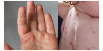 തക്കാളി പനി ; ശ്ര​ദ്ധിക്കേണ്ട ചില കാര്യങ്ങൾ