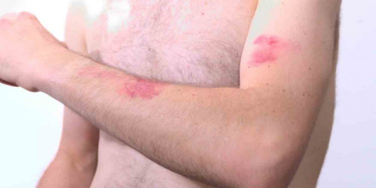 കുരങ്ങുപനി 16 രാജ്യങ്ങളിൽ; 108 പേർക്ക് സ്ഥിരീകരിച്ചു