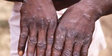 കുരങ്ങുപനി ; രോഗികളുടെ എണ്ണം ഇനിയും വർദ്ധിച്ചേക്കാമെന്ന് ലോകാരോ​ഗ്യ സംഘടന