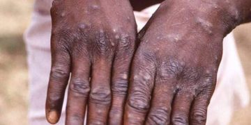 കൊവിഡ് ഭീഷണി ഒഴിയും മുമ്പ് കുരങ്ങുപനി വ്യാപിക്കുന്നു; ആശങ്ക അകലുന്നില്ല