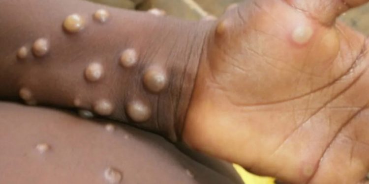 രോഗം കൂടുന്നു, മങ്കിപോക്സ് ആഗോള പകർച്ച വ്യാധി; പ്രഖ്യാപിച്ച് ലോകാരോഗ്യ സംഘടന
