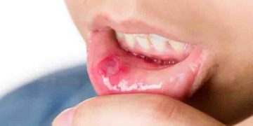 വായ്പ്പുണ്ണ് ഇടയ്ക്കിടെ വരാറുണ്ടോ? എങ്കിൽ ഇവ ഉപയോ​ഗിച്ചാൽ മതി