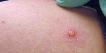 മങ്കിപോക്സ് പടരുന്നു ; കുട്ടികളിൽ പ്രധാനമായി ശ്രദ്ധിക്കേണ്ടത്…