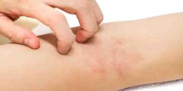 സ്കിൻ ചൊറിച്ചില്‍- അണുബാധ; ധരിക്കുന്ന വസ്ത്രത്തിനും പങ്കുണ്ട്