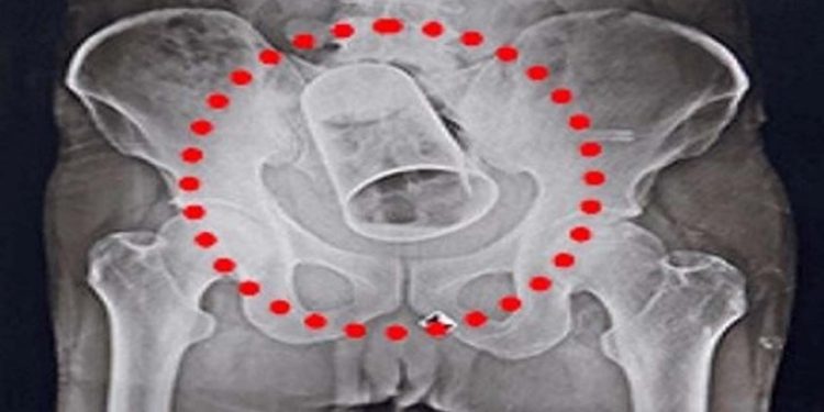 മദ്യലഹരിയിൽ യുവാവിന്റെ സ്വകാര്യഭാഗത്ത് സ്റ്റീൽ ഗ്ലാസ് കുത്തിക്കയറ്റി സുഹൃത്തുക്കൾ