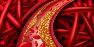 മോശം കൊളസ്ട്രോൾ കുറയ്ക്കാൻ ശ്രദ്ധിക്കേണ്ട ചില കാര്യങ്ങളിതാ…