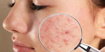 മുഖക്കുരുവിന്‍റെ പാടുകള്‍ അകറ്റാൻ ഇതാ 5 ചേരുവകൾ