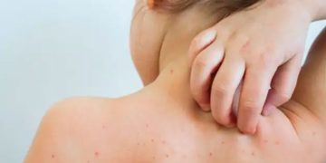 അഞ്ചാംപനി വ്യാപനം; കേരളം ഉൾപ്പെടെ മൂന്ന് സംസ്ഥാനങ്ങളിലേക്ക് കേന്ദ്ര സംഘം