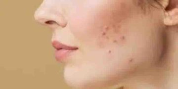 ഇവ ഉപയോ​ഗിച്ചാൽ മതി, മുഖക്കുരുവിന്‍റെ പാടുകൾ അകറ്റാം…