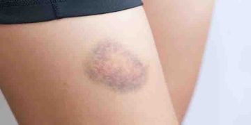 മുറിവുകള്‍ ഉണ്ടാകുമ്പോള്‍ രക്തം പോകുന്നത് നിലയ്ക്കാനും ചതവില്ലാതിരിക്കാനും…