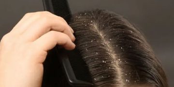 താരൻ അകറ്റാൻ ഇതാ മൂന്ന് വഴികൾ