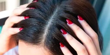 താരൻ അകറ്റാൻ ഇതാ നാല് വഴികൾ…