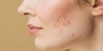 ഇവ ഉപയോ​ഗിച്ചാൽ മതി, മുഖക്കുരുവിന്‍റെ പാടുകൾ അകറ്റാം…