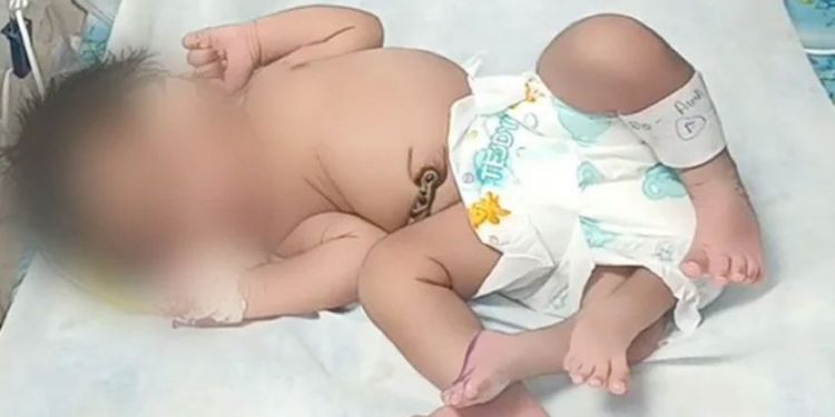 ഗ്വാളിയറിൽ നാല് കാലുകളുമായി പെൺകുഞ്ഞ് പിറന്നു; അപൂർവം