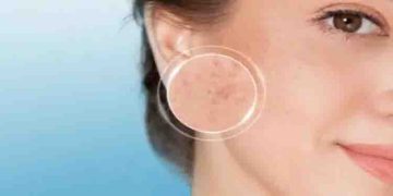 ഇവ ഉപയോഗിച്ചാല്‍ മതി, മുഖത്തെ കറുത്ത പാടുകള്‍ മാറ്റാം…