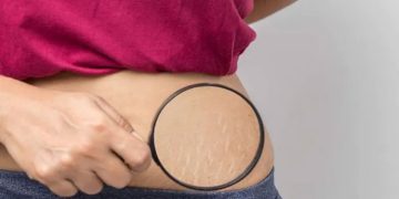 ഗർഭകാലത്തെ സ്ട്രെച്ച് മാർക്കുകൾ ഒഴിവാക്കാൻ ഇതാ ചില വഴികൾ