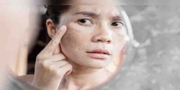 മുഖത്തെ കറുത്ത പാടുകള്‍ മാറ്റാന്‍ വീട്ടില്‍ പരീക്ഷിക്കാം ഈ നാല് ഫേസ് പാക്കുകള്‍…