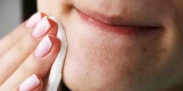 ബ്ലാക്ക്ഹെഡ്‌സ് എങ്ങനെ ഒഴിവാക്കാം? വീട്ടില്‍ പരീക്ഷിക്കാം ഈ ഏഴ് പൊടിക്കൈകള്‍…