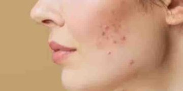 മുഖക്കുരുവും മുടി കട്ടി കുറയലും, കൊഴിച്ചിലും; സ്ത്രീകള്‍ ശ്രദ്ധിക്കേണ്ട ലക്ഷണങ്ങള്‍…