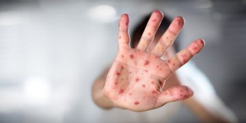 2023ല്‍ ഭയക്കേണ്ടത് കോവിഡിനെ അല്ല; മറിച്ച് നൂറ്റാണ്ടുകള്‍ പഴക്കമുള്ള ഈ രോഗത്തെ