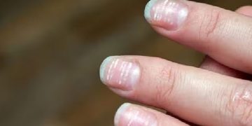 നഖങ്ങളിലെ വരകളും നിറംമാറ്റവും പൊട്ടലും എന്തുകൊണ്ട്? ഈ പരിഹാരം ചെയ്തുനോക്കൂ…