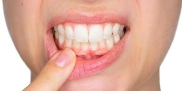 മോണരോഗവും ഹൃദ്രോഗവും തമ്മിൽ ബന്ധമുണ്ടോ? പുതിയ പഠനം പറയുന്നത്