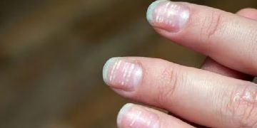 നഖങ്ങളിലെ വരകളും നിറംമാറ്റവും പൊട്ടലും എന്തുകൊണ്ട്? ഈ പരിഹാരം ചെയ്തുനോക്കൂ…