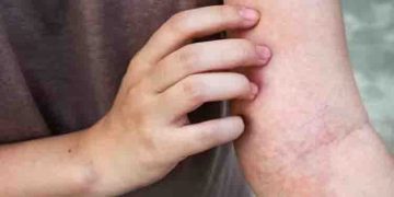 ശരീരത്തിലെ ചൊറിച്ചില്‍ അവഗണിക്കരുത്; ആരംഭത്തിൽ തന്നെ ഈ രോഗലക്ഷണങ്ങൾ തിരിച്ചറിയാം