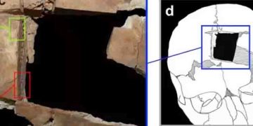 വെങ്കലയുഗത്തില്‍ മനുഷ്യന്‍ മസ്തിഷ്ക ശസ്ത്രക്രിയ ചെയ്തെന്ന് പുരാവസ്തു ഗവേഷകര്‍ !