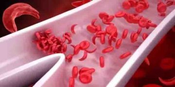 എന്താണ് അരിവാള്‍ രോഗം? ലക്ഷണങ്ങൾ എന്തൊക്കെ? അറിയേണ്ടതെല്ലാം…