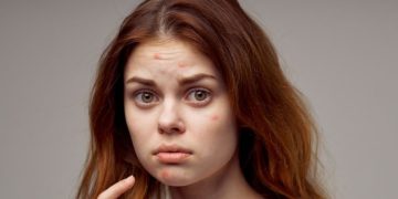 ഈ കാര്യങ്ങൾ ശ്രദ്ധിച്ചാൽ മുഖക്കുരു തടയാം