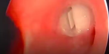 നാല് വയസുകാരന്റെ തൊണ്ടയില്‍ കുടുങ്ങിയ ‘വിസില്‍’ വിജയകരമായി പുറത്തെടുത്തു