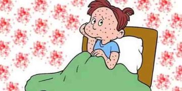 വേനലിനൊപ്പം പടര്‍ന്ന് ചിക്കൻപോക്സ്; ശ്രദ്ധിക്കേണ്ട കാര്യങ്ങൾ…