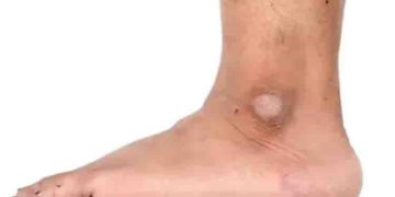 കാലില്‍ നിറവ്യത്യാസവും പാടുകളും കാഴ്ചയ്ക്ക് മങ്ങലും; തിരിച്ചറിയാം ഈ പ്രശ്നത്തെ…