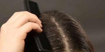 താരനകറ്റാൻ ഈ നാല് ചേരുവകൾ ഉപയോ​ഗിക്കാം