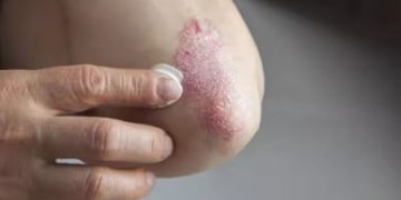 തൊലിപ്പുറത്ത് കാണുന്ന ഈ രോഗം വേനലില്‍ എങ്ങനെ നിയന്ത്രിക്കാം?