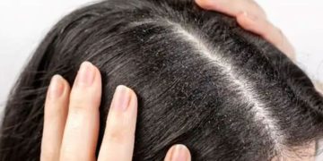 താരനും മുടികൊഴിച്ചിലും കുറയ്ക്കാൻ ഇതാ ഒരു പൊടിക്കെെ