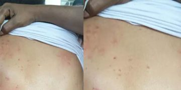 മെഡിക്കൽ കോളജിൽ മൂട്ടശല്യം; ഗർഭിണിയെ മറ്റൊരു വാർഡിലേയ്ക്ക് മാറ്റി